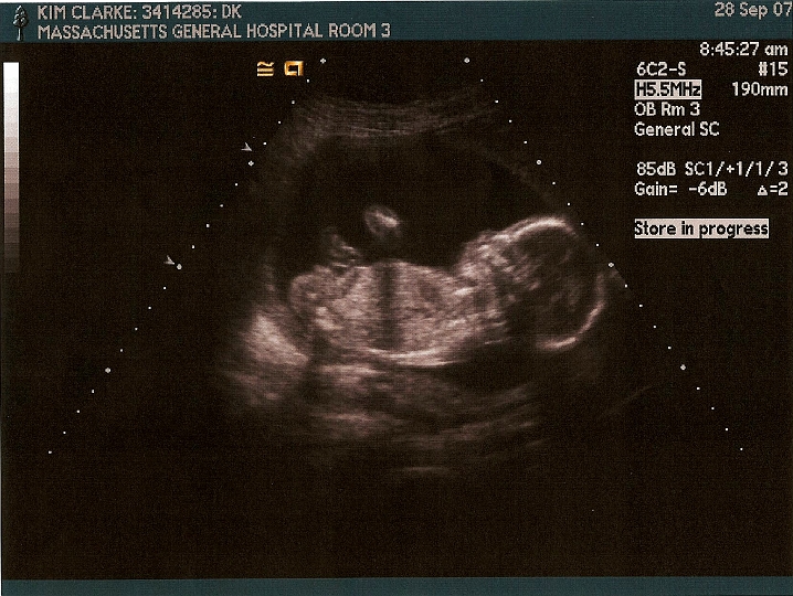 Ultrasounds_005a.jpg - The next three are probably the last series we will have.  Estimated at 18 weeks.  We found out the sex...