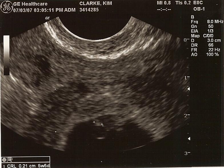 Ultrasounds_01.jpg - Estimated at 5 weeks, 5 days.  The journey begins...