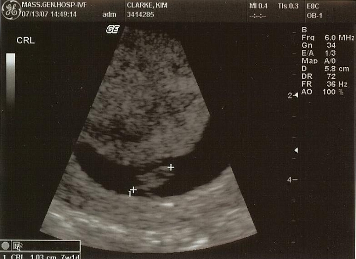 Ultrasounds_02.jpg - Estimated at 7 weeks, 1 day