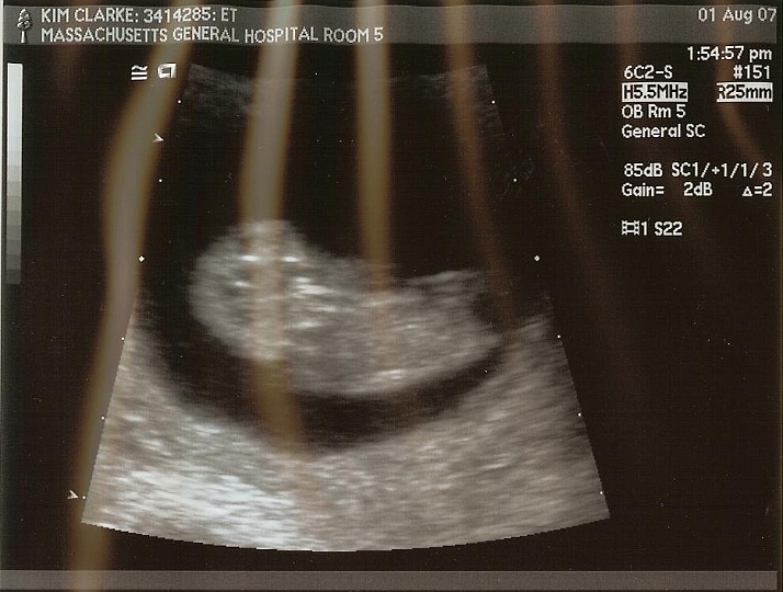 Ultrasounds_03a.jpg - I think the next four were taken at around 10 weeks
