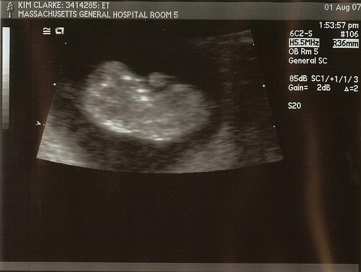 Ultrasounds_03b.jpg - @10 weeks