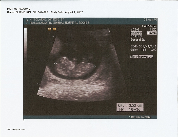 Ultrasounds_03c.jpg - @10 weeks.  They used the good paper here :-)
