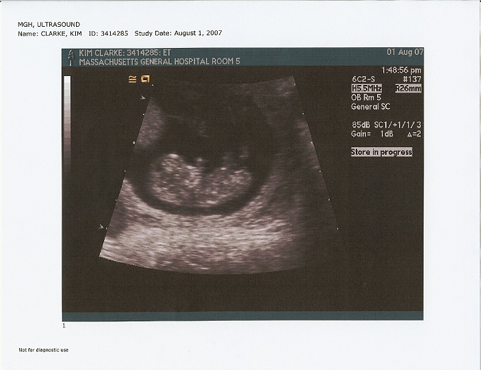 Ultrasounds_03d.jpg - @10 weeks
