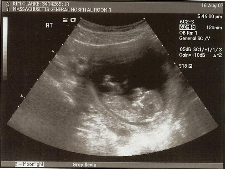 Ultrasounds_04a.jpg - The next three were taken the day before my birthday.  What a great Birthday present, huh!  Estimated at 12 weeks.