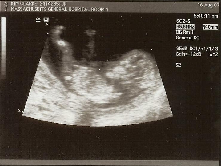 Ultrasounds_04b.jpg - @12 weeks