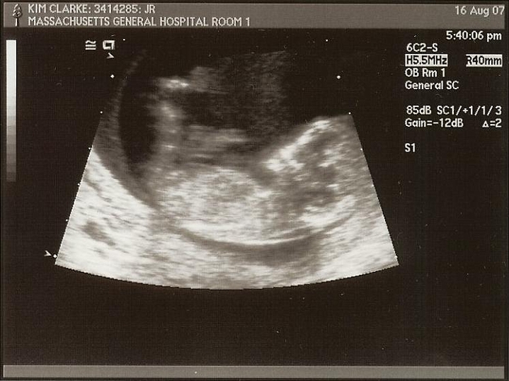Ultrasounds_04c.jpg - @12 weeks.  More to come...